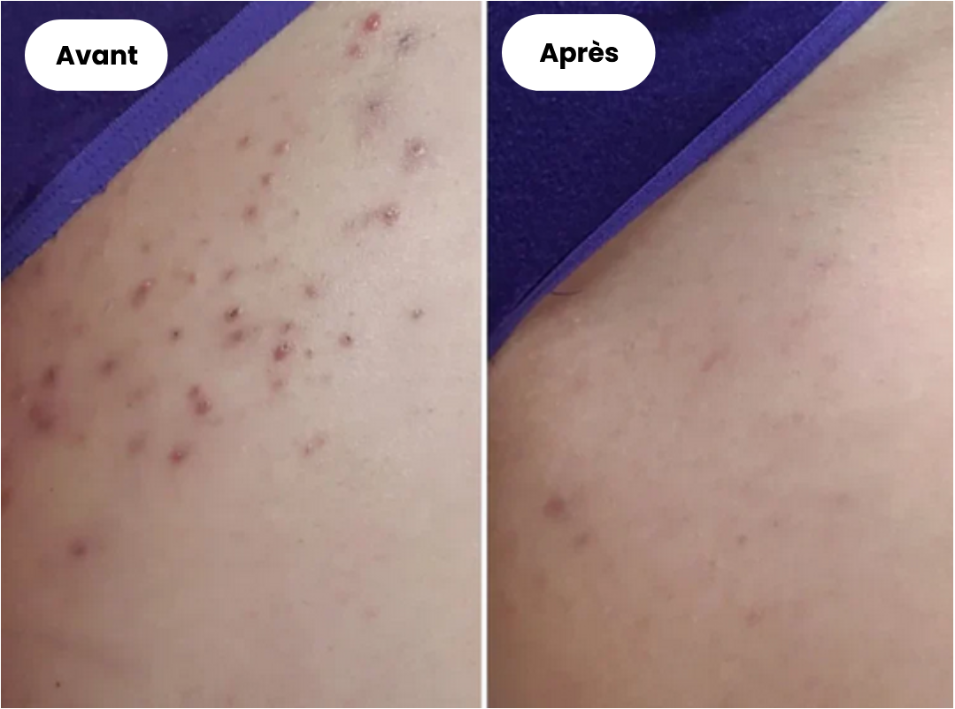 Epilation ProLiss, votre allié beauté pour une peau lisse en toute sérénité.