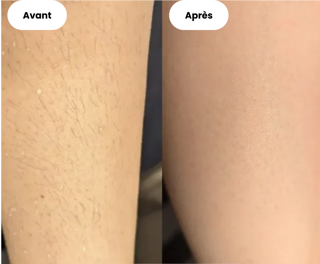 Épilateur ProLiss, votre allié beauté pour une peau lisse en toute sérénité.